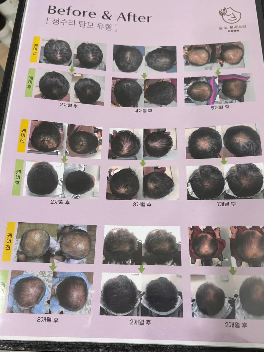 डोनो फोरेस्टा सानबोन प्राइवेट स्कैल्प केयर समीक्षा के कस्टमाइज्ड ट्रीटमेंट स्टेप्स