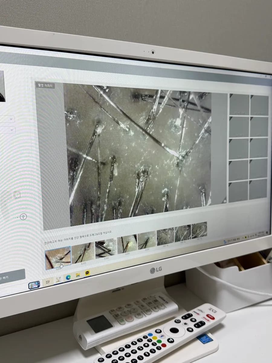 Consulta con fotos del cuero cabelludo antes del cuidado temprano de la caída del cabello SMD